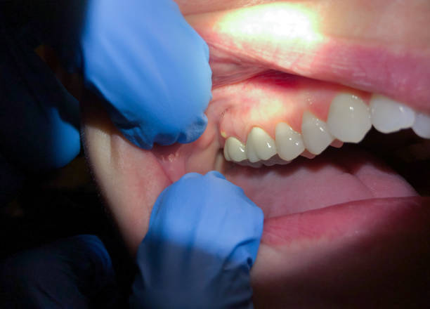 Best Dental Abscess Treatment in North Druid Hills, GA